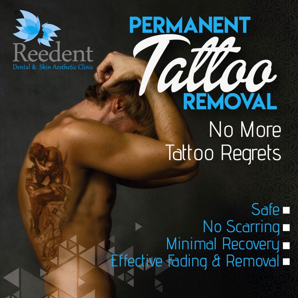 Permanent Tattoo Removal